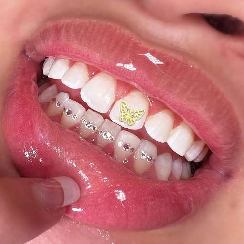 Y2k Butterfly Tooth Gems Kit Minimalist Tooth Decoration - Temu